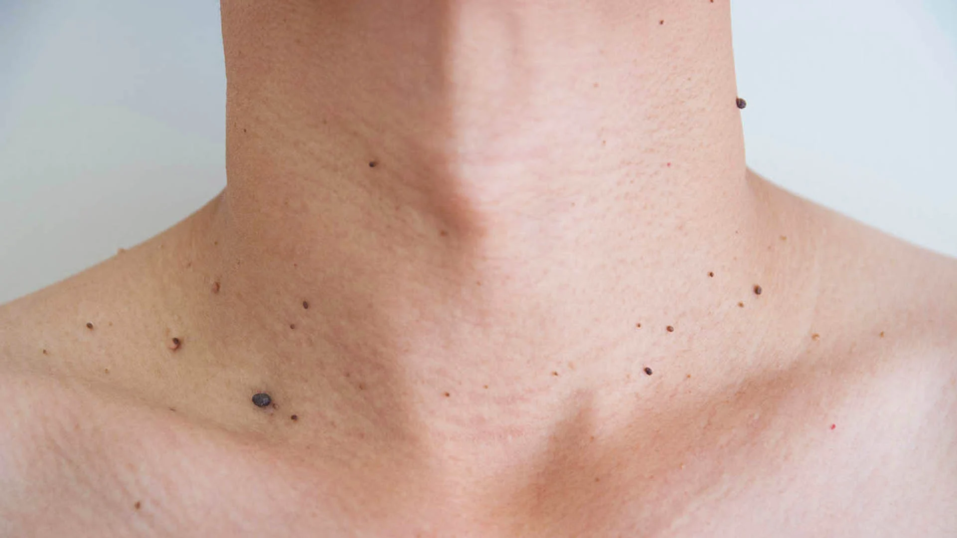 Papiloame – Ce sunt, de ce apar și cum le tratăm