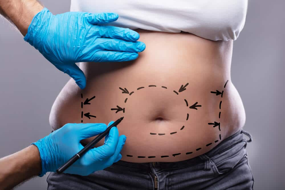 De ce merită să alegeți abdominoplastia: beneficii medicale și estetice?